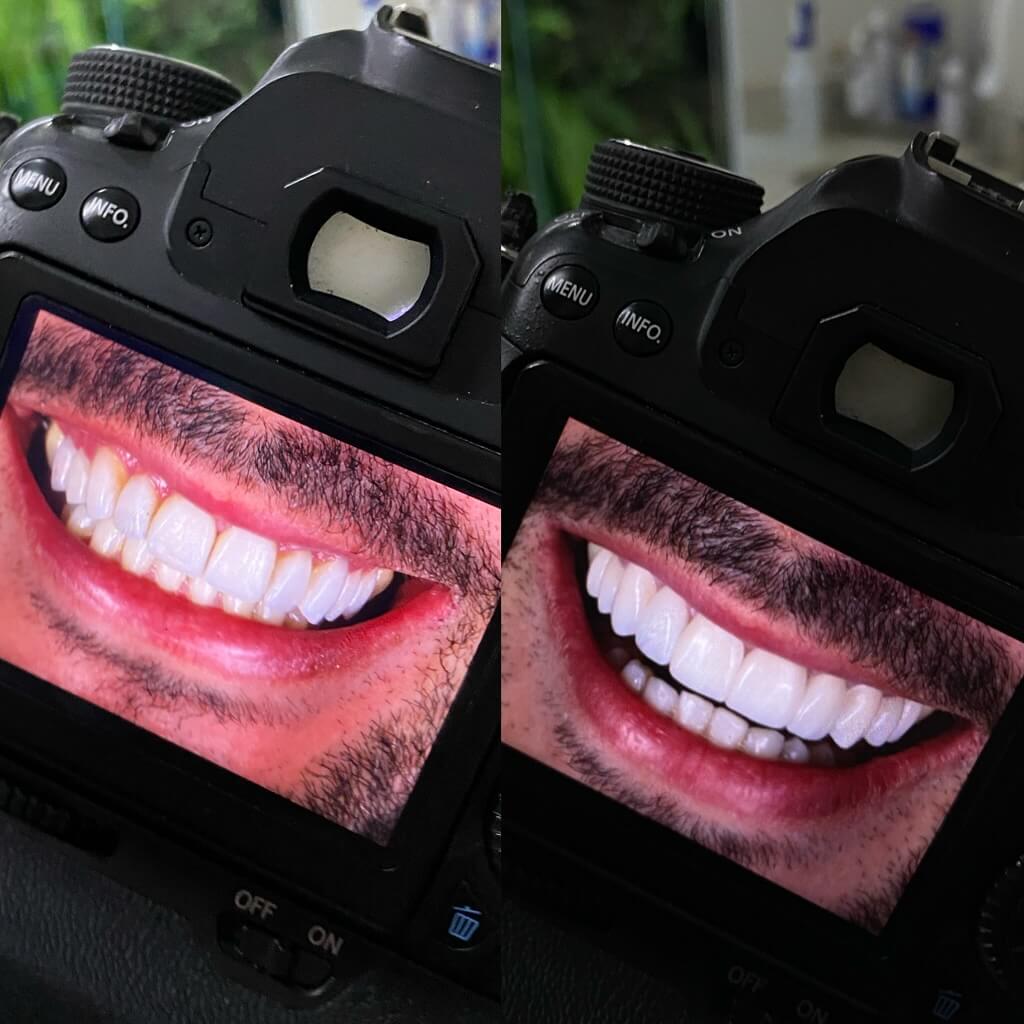 Caso Clínico 2 - Textura e Polimento