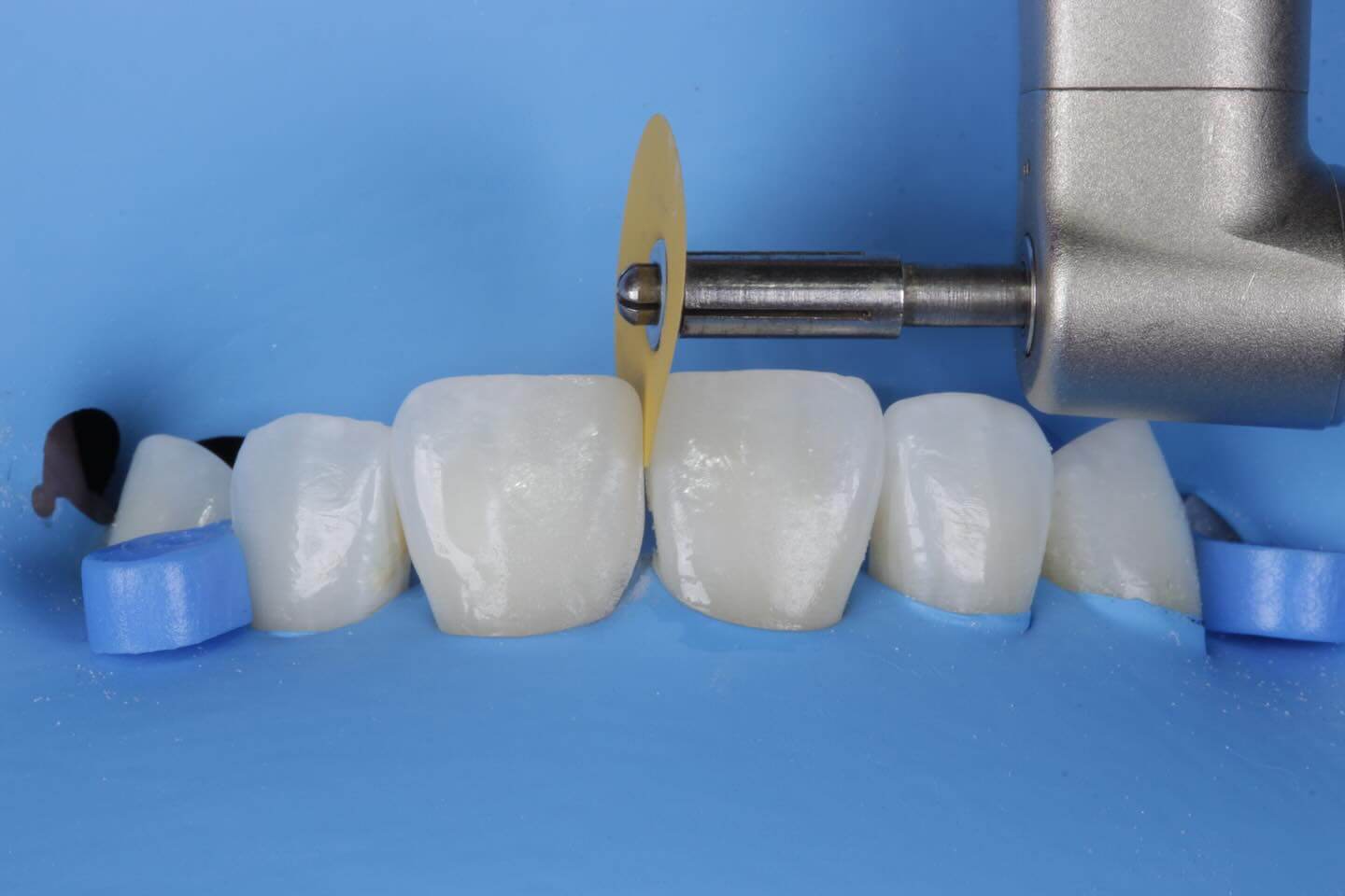 Caso Clínico 3 - Dente Escurecido