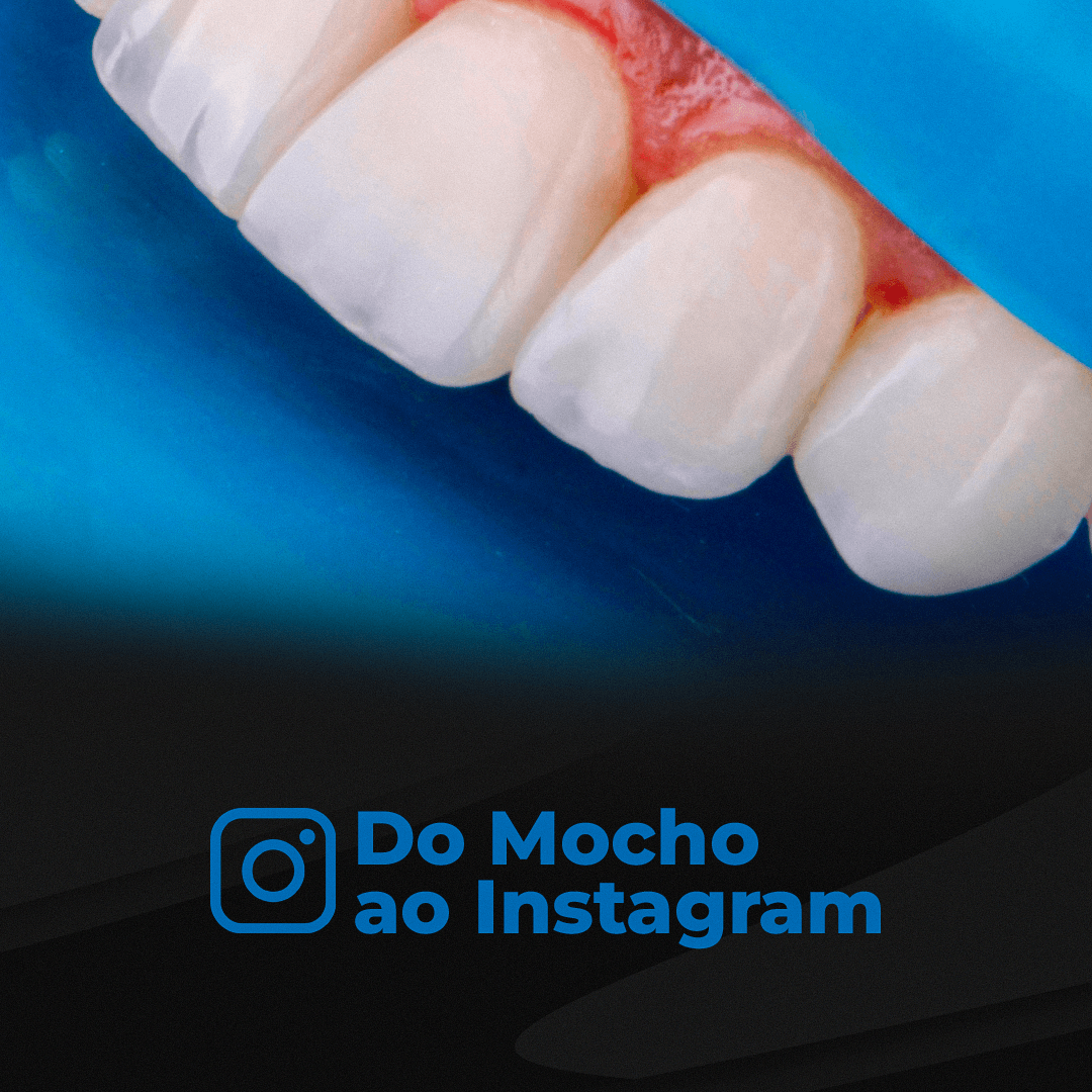 Caso de Dente Escurecido Resolvido